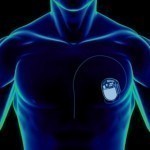 Подкожно установленные кардиостимуляторы могут попасть под управление хакеров