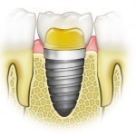 Нужна ли имплантация зубов?