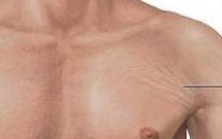 Растяжки на теле у мужчин: профилактика и причины появления