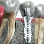 Что такое эстетическая реставрация зубов