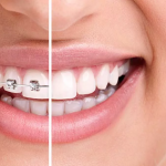 Как исправить прикус: секреты Как исправить прикус: секреты