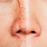 Лазерное удаление пигментации: все плюсы и минусы этого метода