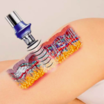 Ударно-волновая терапия в косметологии: технология нового поколения Ударно-волновая терапия в косметологии: технология нового поколения