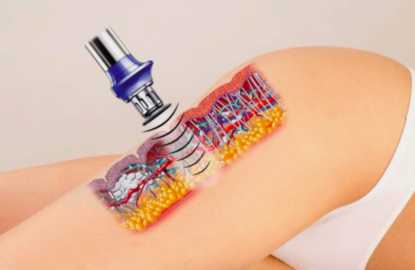 Ударно-волновая терапия в косметологии: технология нового поколения