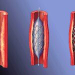 Лечение атеросклероза сосудов Лечение атеросклероза сосудов