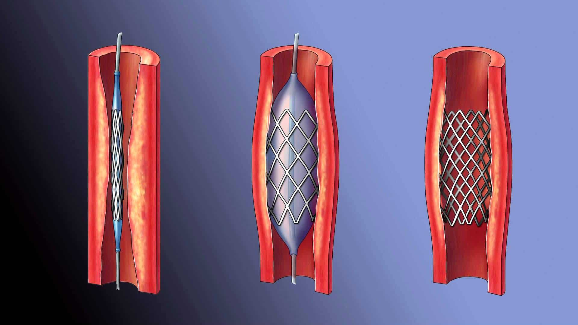 Лечение атеросклероза сосудов