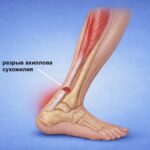 Операция на ахилловом сухожилии показания, методы лечения и восстановление