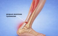 Операция на ахилловом сухожилии показания, методы лечения и восстановление