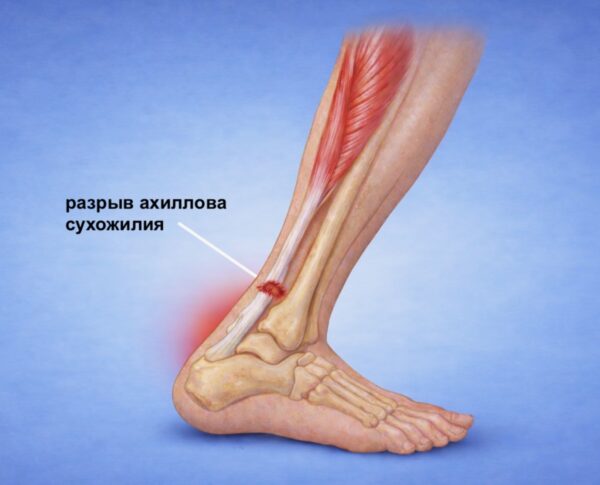 Операция на ахилловом сухожилии показания, методы лечения и восстановление