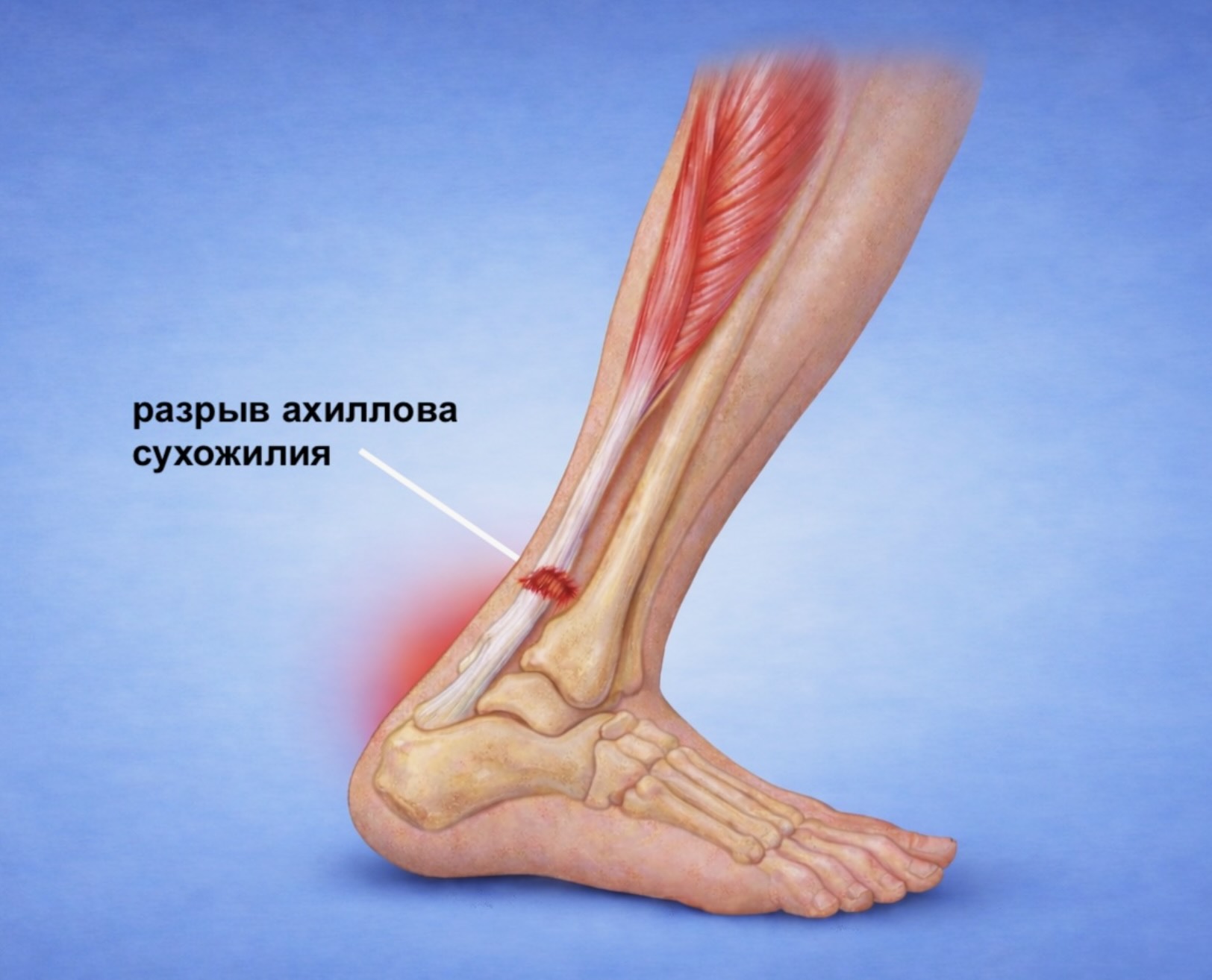 Операция на ахилловом сухожилии: показания, методы лечения и восстановление