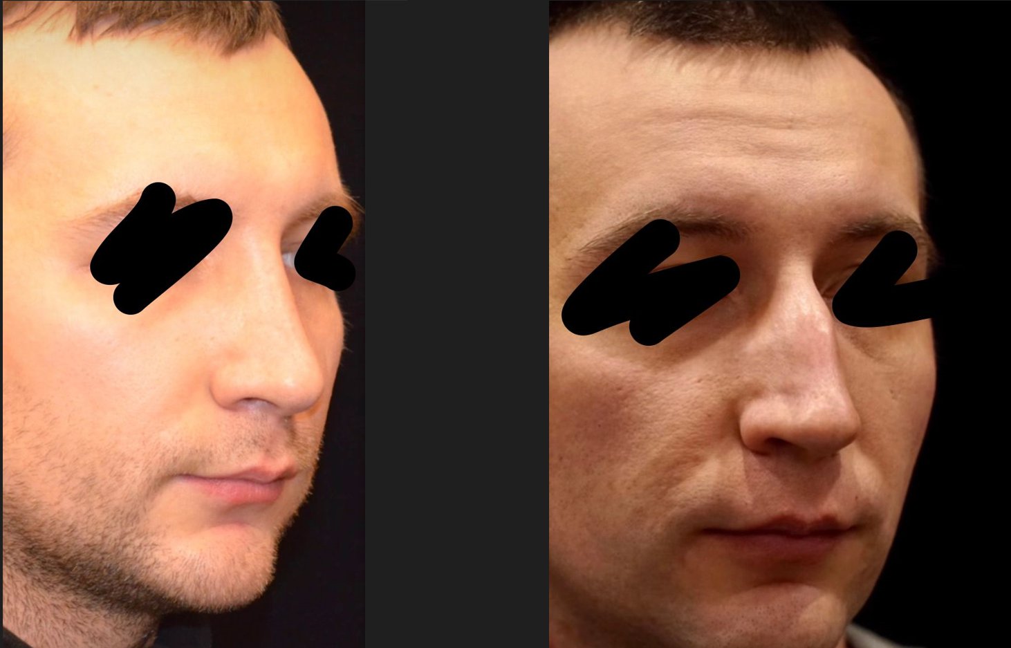 Лазарев нос поправила. Искривление перегородки носа. Лазерное исправление носа.